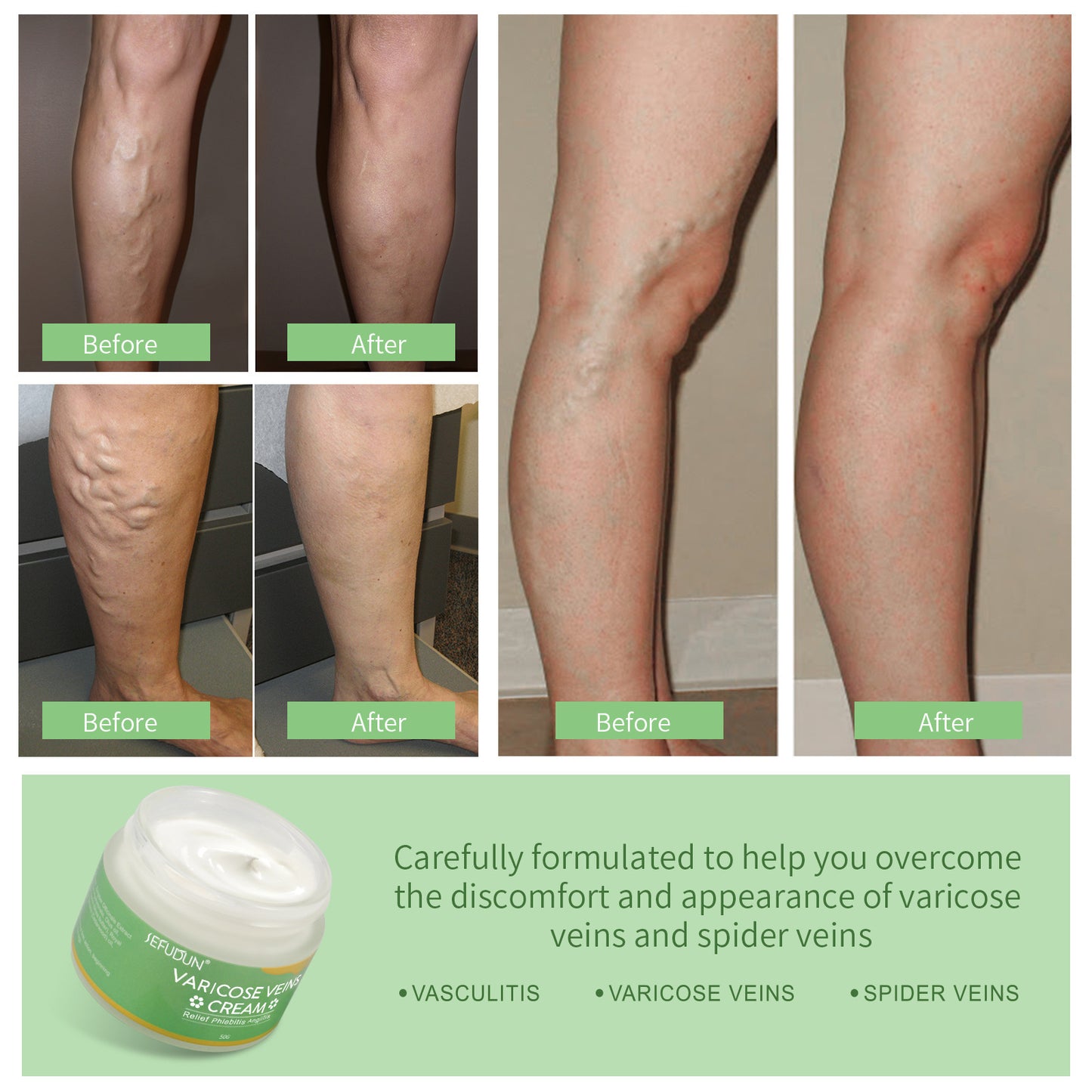 Vein Cream - Varicose & Bruise Relief